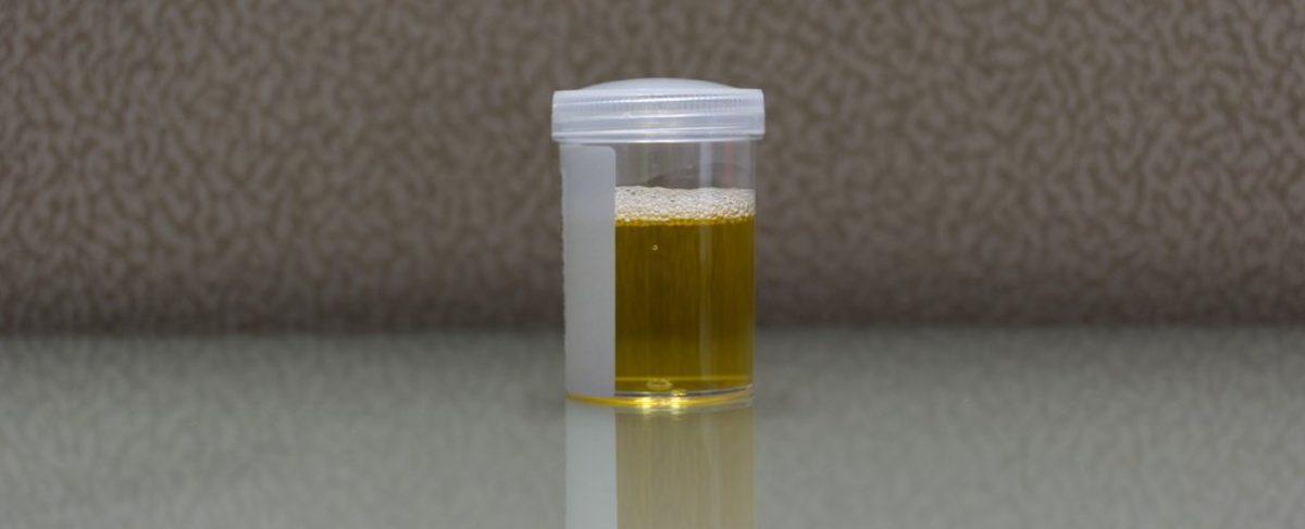 Tıp Tarihinde İlk: Bir Kadının İdrar Yerine Alkol Ürettiği Ortaya Çıktı