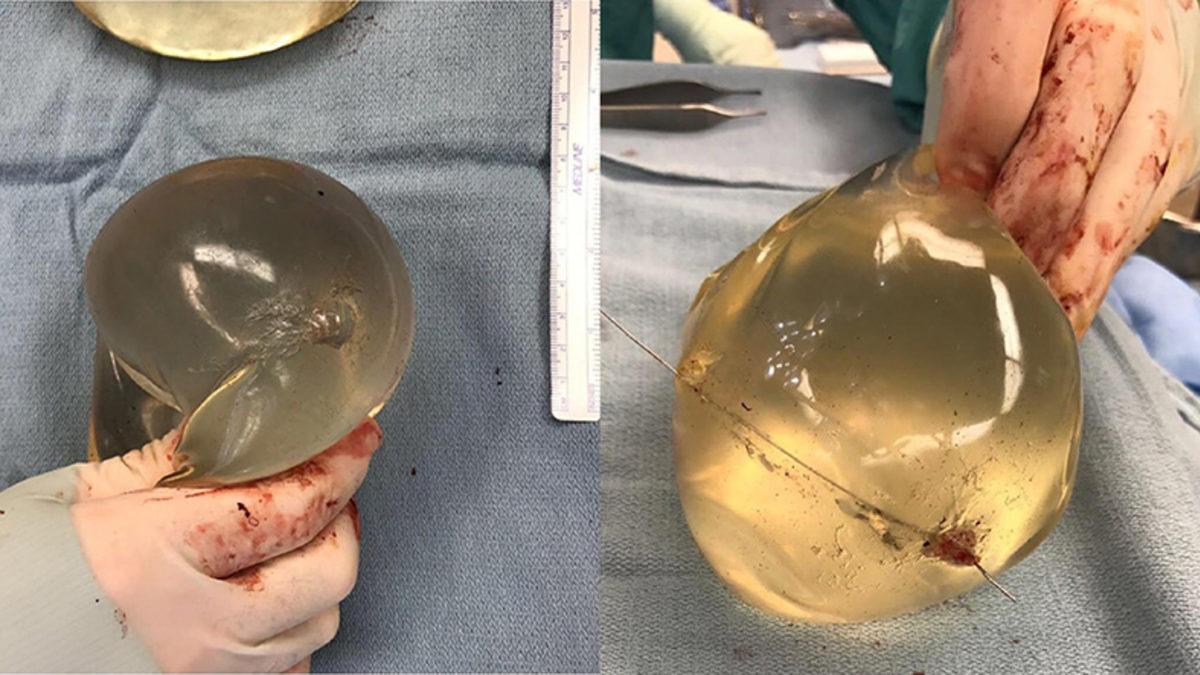 Silahla Vurulan Kadın, Göğsündeki Silikon Sayesinde Ölmekten Kurtuldu