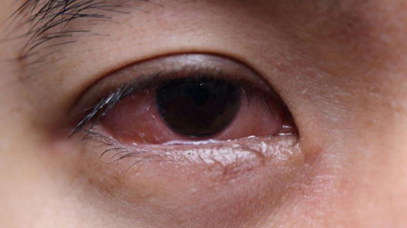 Araştırmalara Göre Koronavirüs, Gözlerde 20 Günden Fazla Yaşıyor