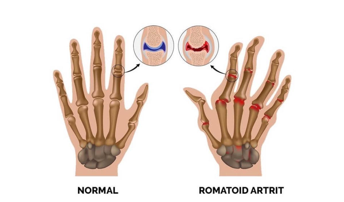 Bilim İnsanları, İltihaplı Romatizma İçin Yeni Bir İlaç Geliştirdi