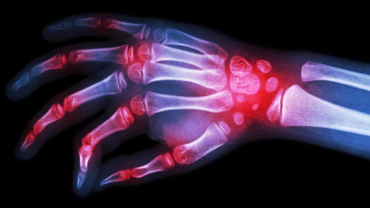 Bilim İnsanları, İltihaplı Romatizma İçin Yeni Bir İlaç Geliştirdi