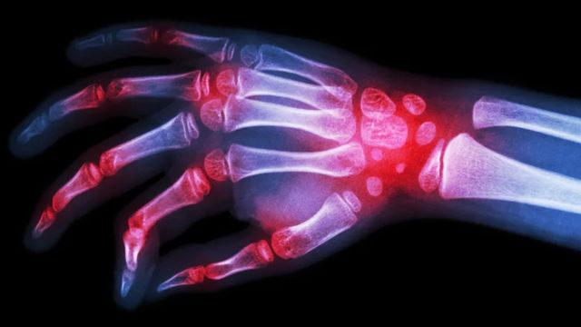 Bilim İnsanları, İltihaplı Romatizma İçin Yeni Bir İlaç Geliştirdi