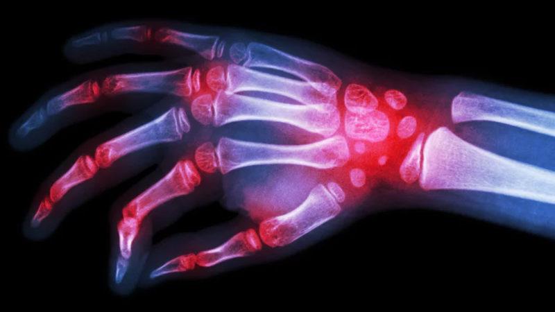 Bilim İnsanları, İltihaplı Romatizma İçin Yeni Bir İlaç Geliştirdi