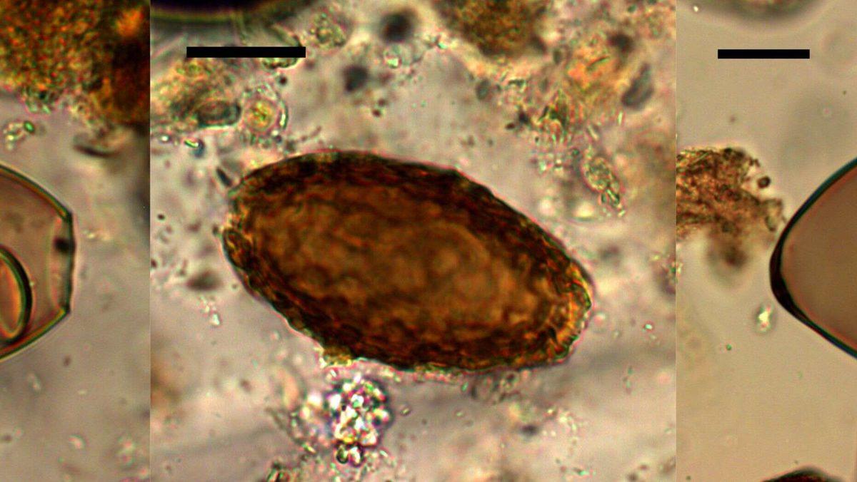 Eski İngilizlerin Böbreklerinde Dev Solucanlar Olduğu Keşfedildi