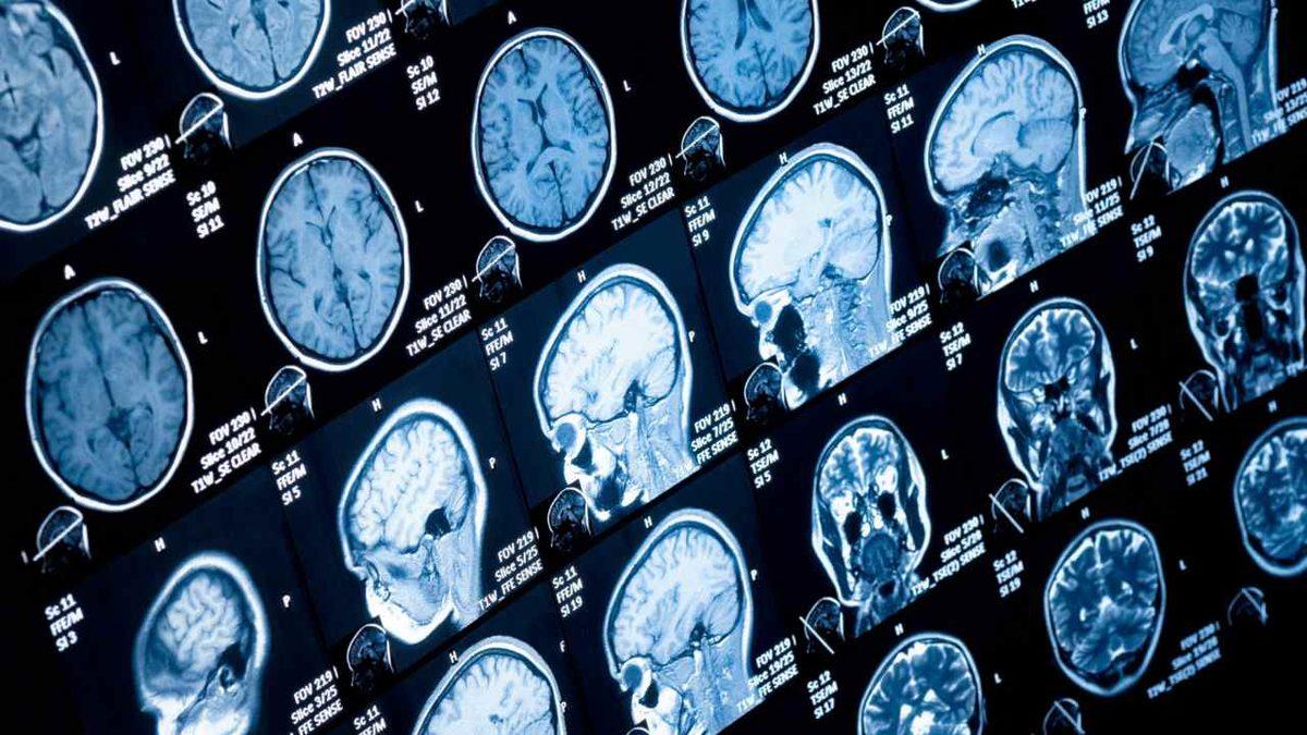 Yapay Bir Beyinde İlk Kez İnsanlardaki Gibi Reaksiyon Gözlemlendi