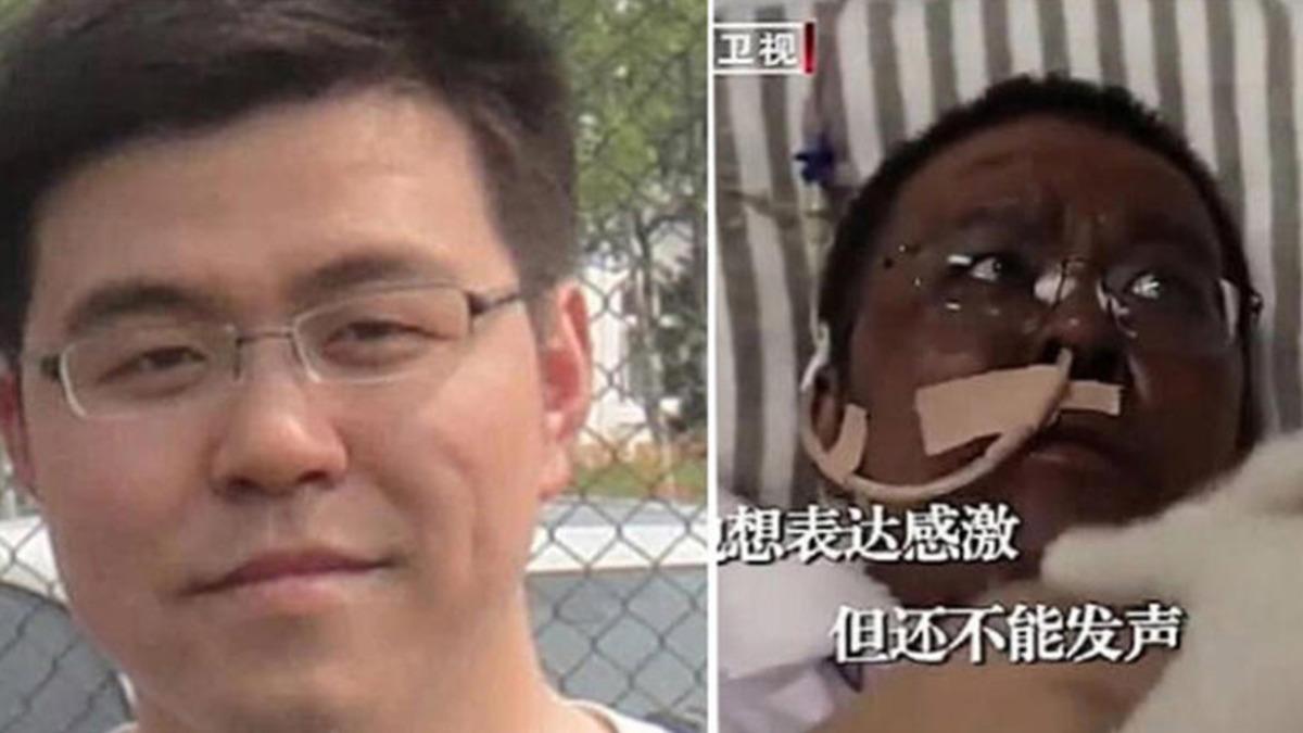 Koronavirüs Nedeniyle Ten Rengi Değişen Çinli Doktor Hayatını Kaybetti