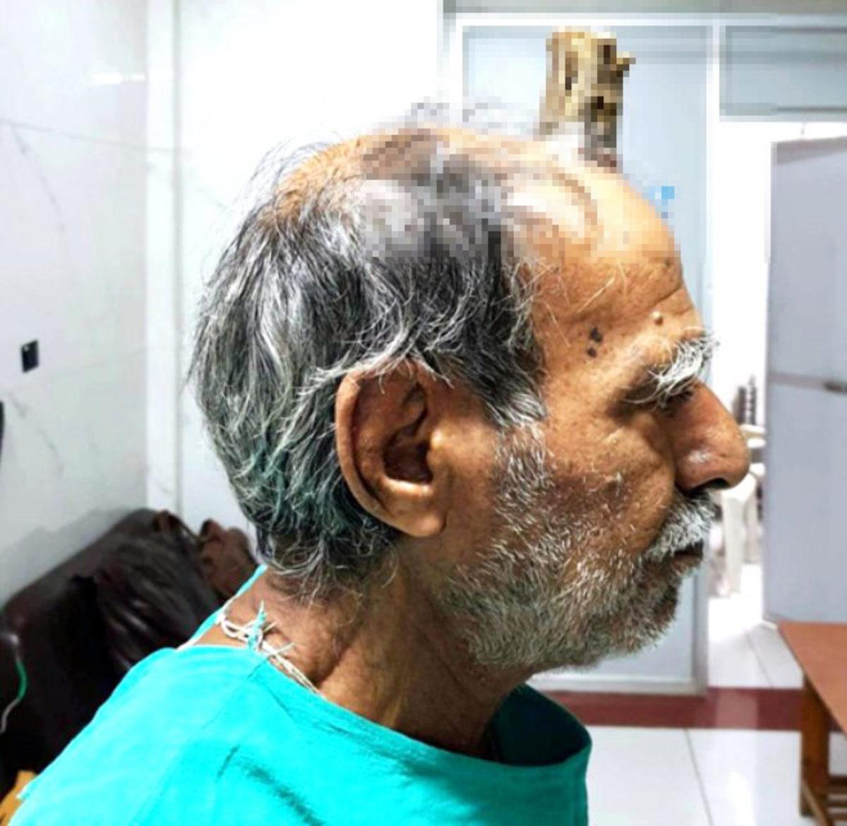 Bir Adamın Kafasında, Başını Çarptıktan 5 Yıl Sonra ’Boynuz’ Çıktı