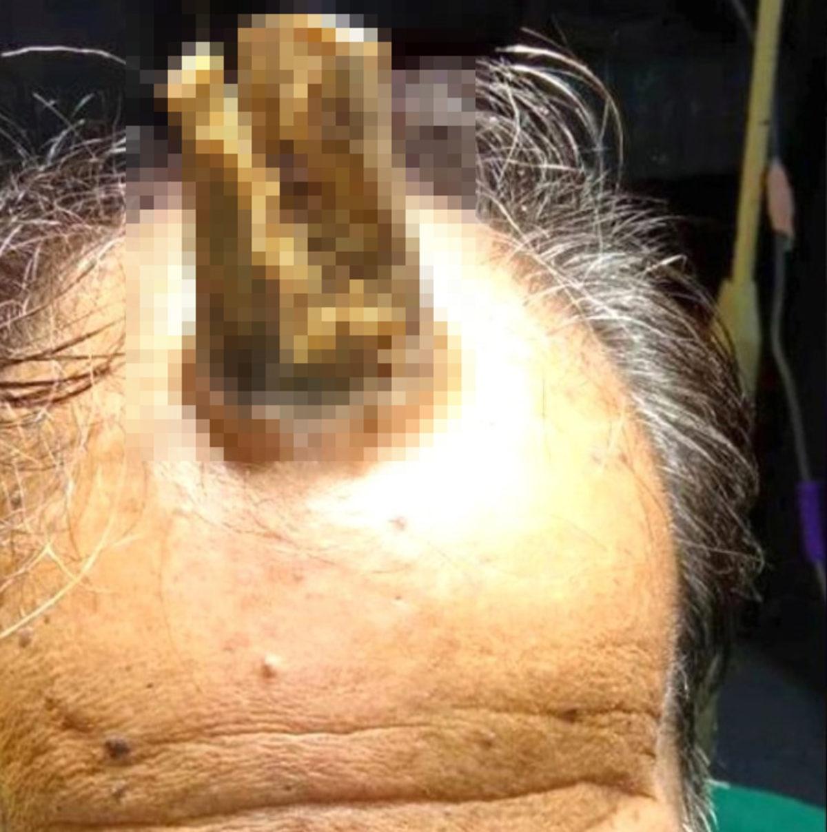 Bir Adamın Kafasında, Başını Çarptıktan 5 Yıl Sonra ’Boynuz’ Çıktı