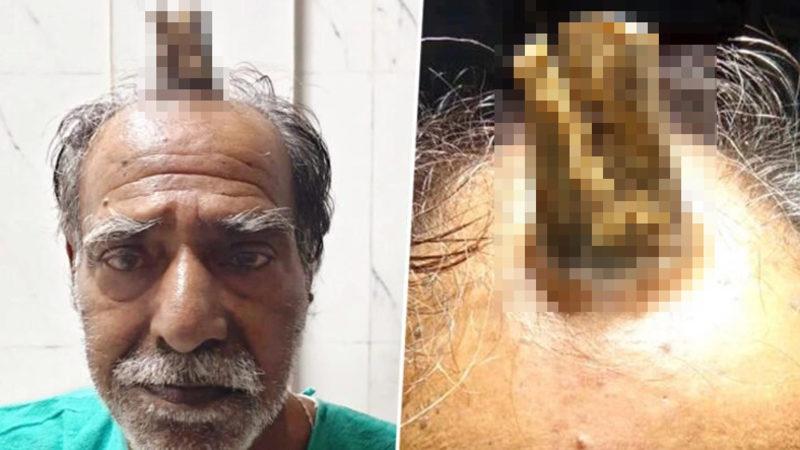 Bir Adamın Kafasında, Başını Çarptıktan 5 Yıl Sonra ’Boynuz’ Çıktı