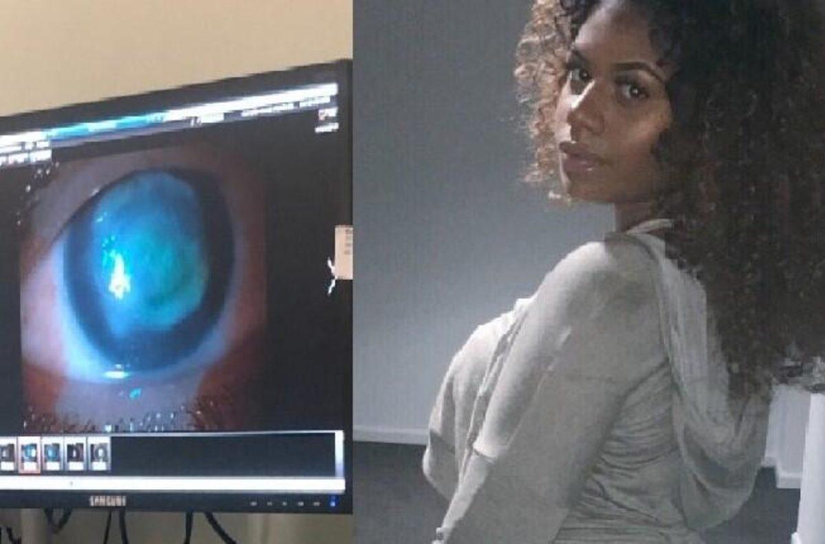 20 Yaşındaki Kadın, Denize Lensleriyle Girdiği İçin Kör Oldu