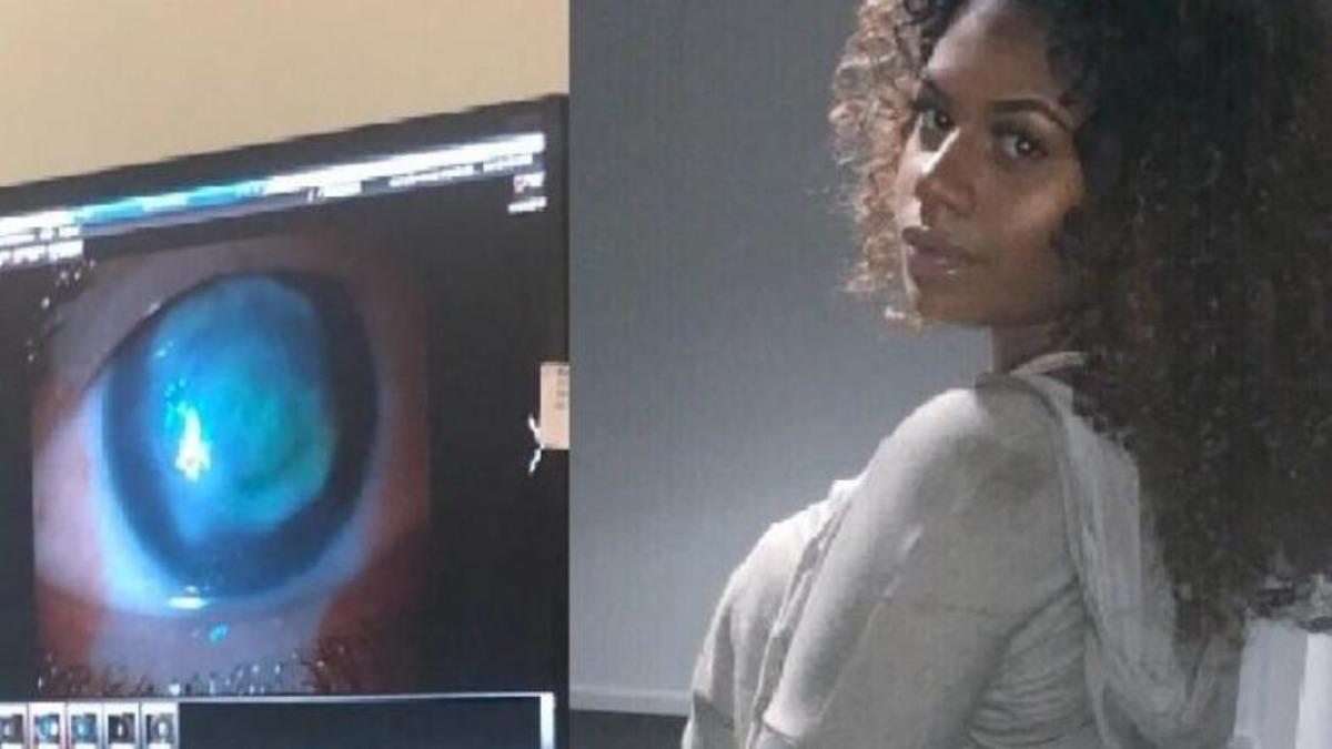 20 Yaşındaki Kadın, Denize Lensleriyle Girdiği İçin Kör Oldu