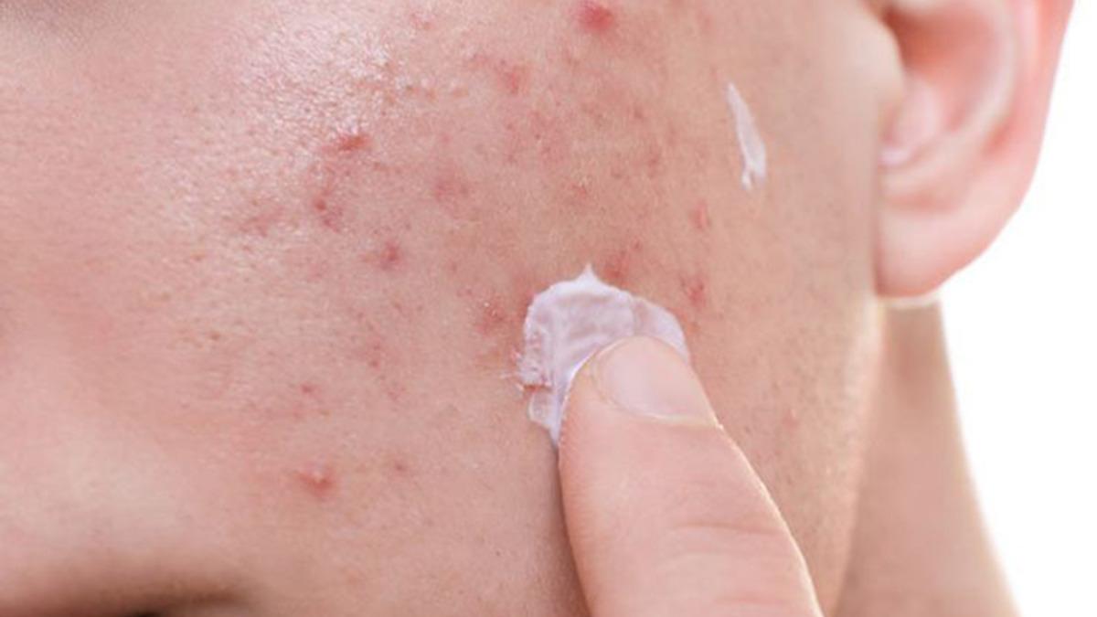 Bilim İnsanları, Sivilcenin Nedenleri Üzerinde Uzlaşamıyor