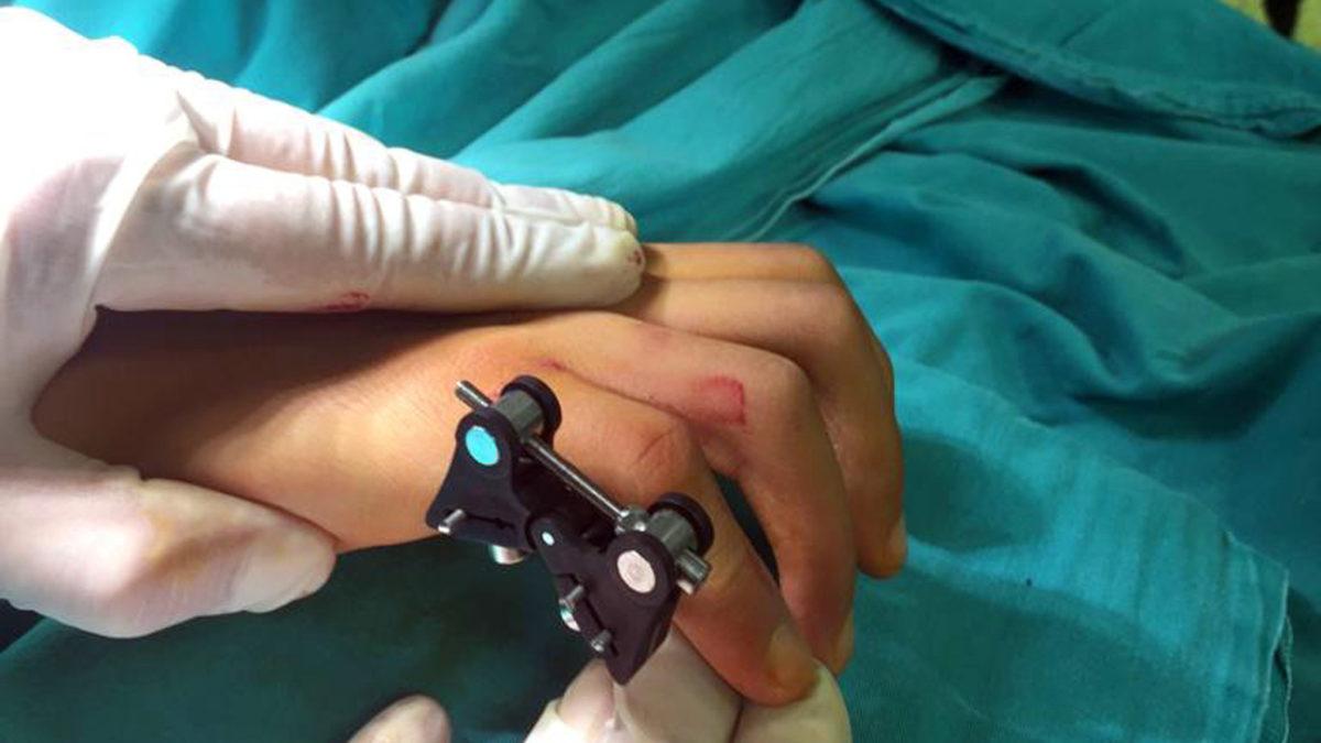 Parmak Eklem Rahatsızlığının Tedavisi İçin Yerli Cihaz Geliştirildi