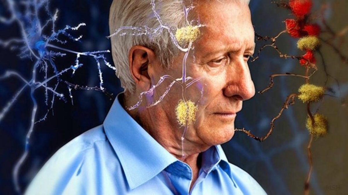 Alzheimer Tedavisinin Geleceği Tek Bir İlaca Bağlı Olmayabilir