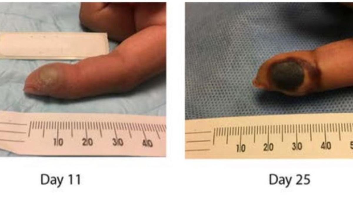 Aşıyı Reddeden Laboratuvar Çalışanı, Yanlışlıkla Kendine Çiçek Hastalığı Bulaştırdı