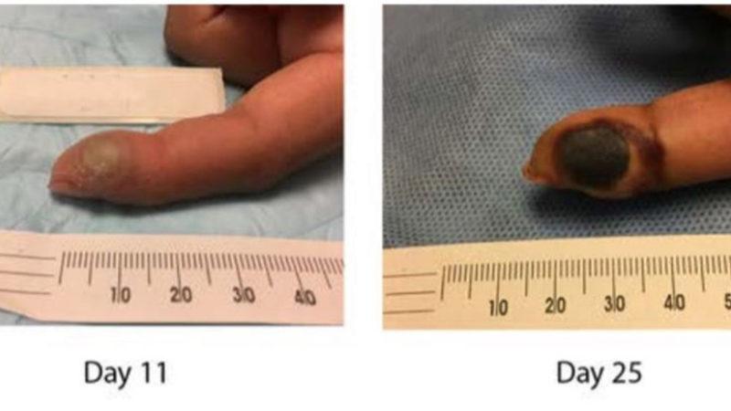 Aşıyı Reddeden Laboratuvar Çalışanı, Yanlışlıkla Kendine Çiçek Hastalığı Bulaştırdı