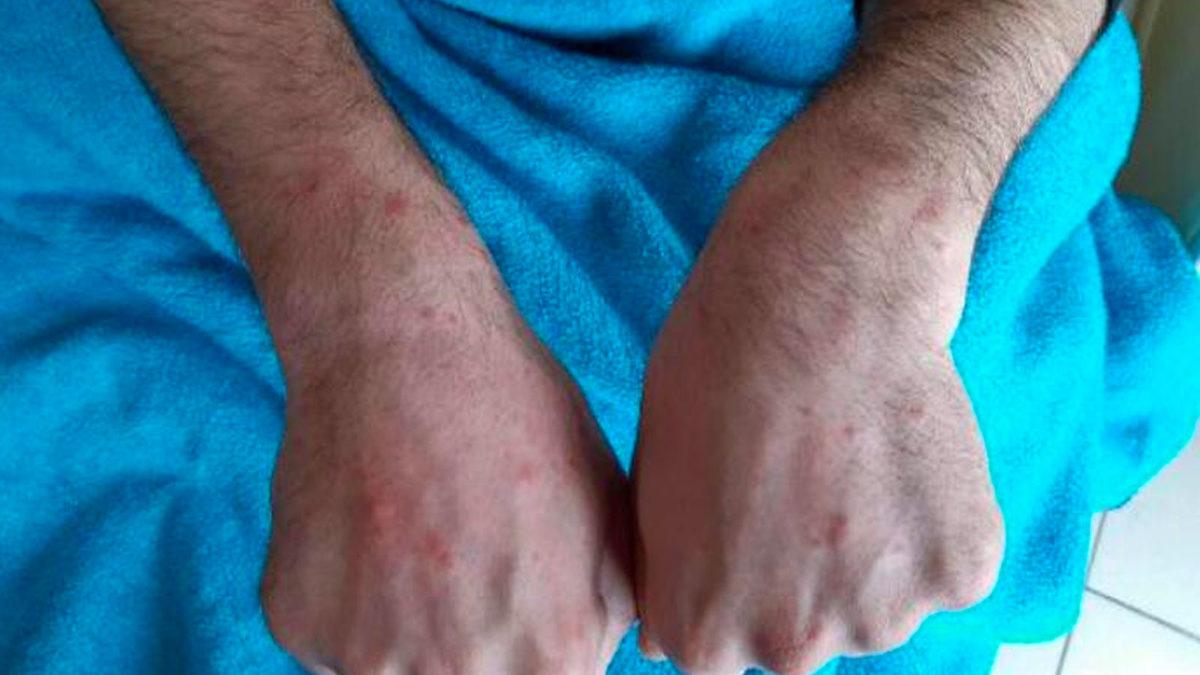 Cerrahpaşa’dan COVID-19 Hastalarında Görülen Deri Döküntülerine İlişkin Açıklama