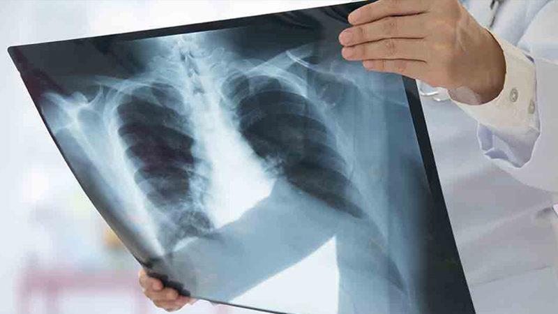 Sağlık Bakanlığı, Günlük Koronavirüs Tablosuna Yeni Bir Veri Ekledi: Zatürre Oranı