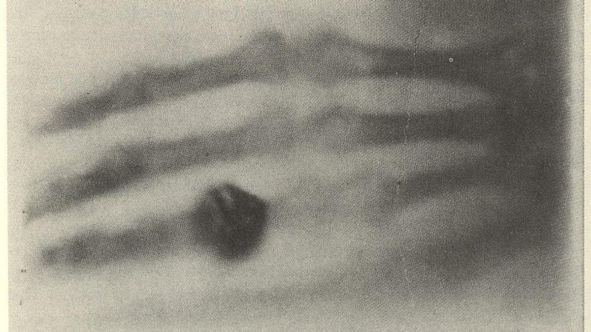 124 Yıl Önce Çekilen İlk Röntgen Filmindeki İlginç Detay