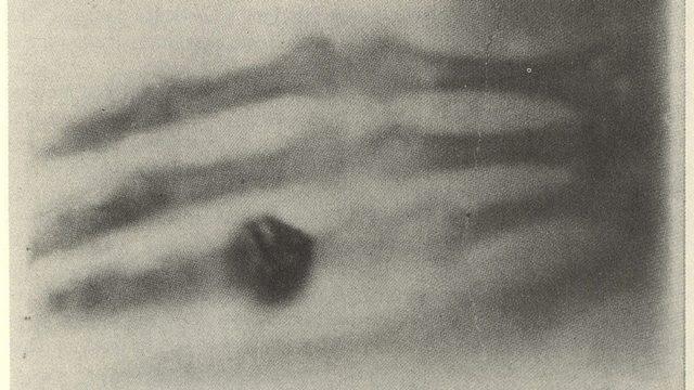 124 Yıl Önce Çekilen İlk Röntgen Filmindeki İlginç Detay