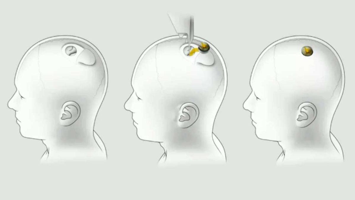 Elon Musk, İnsan Beynini Bilgisayarlara Bağlayan İlk Ticari Cihaz Neuralink’i Tanıttı