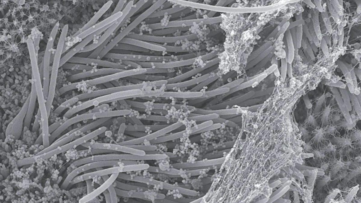 Koronavirüsün Akciğerlerimizi Nasıl ‘Sardığını’ Gösteren Yeni Görüntü