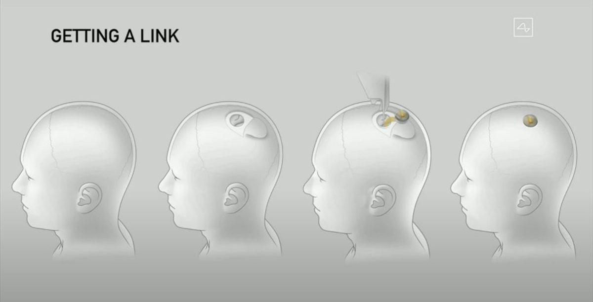 Elon Musk: Akıllı Saatler Dünün, Neuralink Geleceğin Teknolojisi