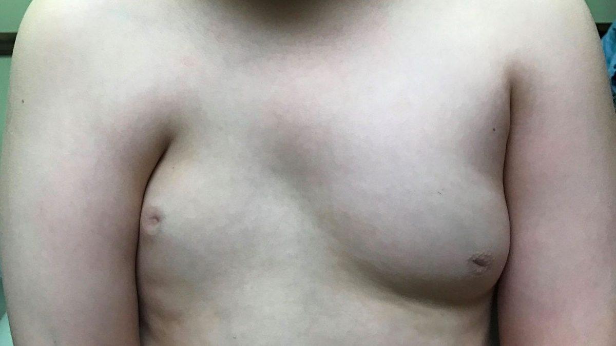 İnsanlarda Doğuştan Meme Olmamasına Sebep Olan Nadir Bir Hastalık: Amastia