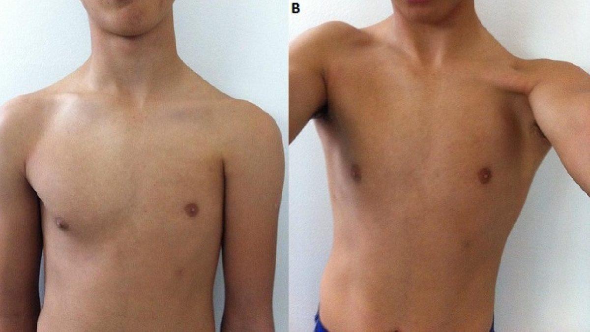 İnsanlarda Doğuştan Meme Olmamasına Sebep Olan Nadir Bir Hastalık: Amastia