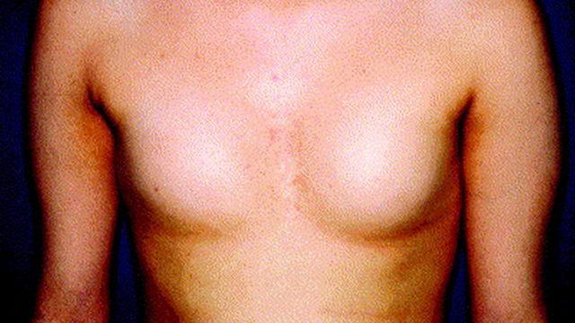 İnsanlarda Doğuştan Meme Olmamasına Sebep Olan Nadir Bir Hastalık: Amastia