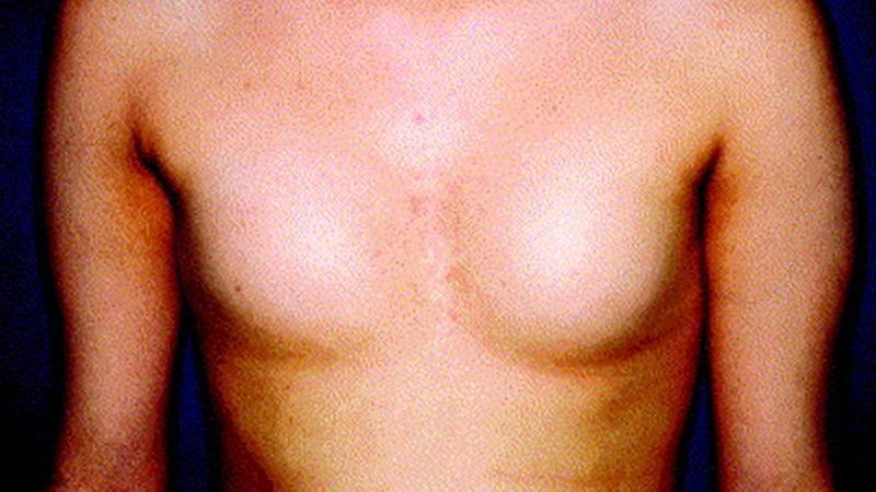 İnsanlarda Doğuştan Meme Olmamasına Sebep Olan Nadir Bir Hastalık: Amastia