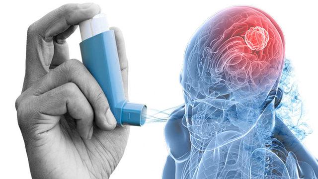 Astım Hastalığının Beyin Tümörünü Engellediği Bilimsel Olarak Kanıtlandı