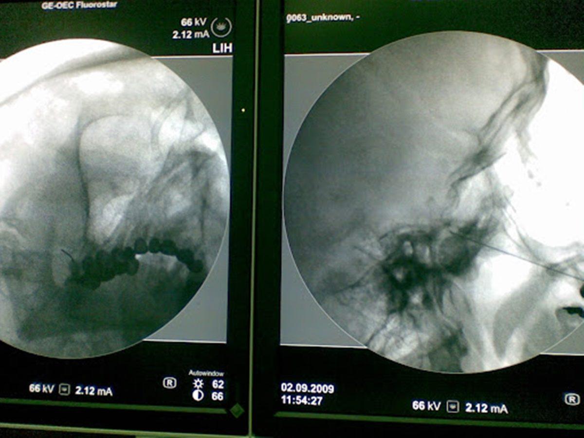 Yaşattığı Şiddetli Ağrı Yüzünden İnsanları Delirtip İntihara Sürükleyen Korkunç Hastalık: Trigeminal Nevralji