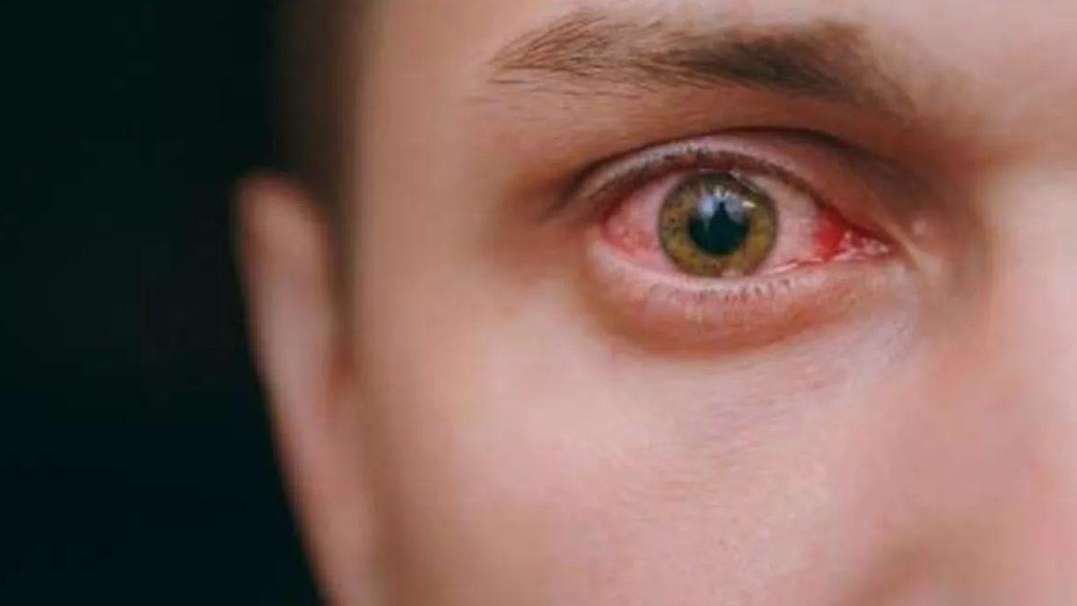 Bilim İnsanlarından Korkutan Yeni Salgın Uyarısı: Görme Kaybına Yol Açabilir