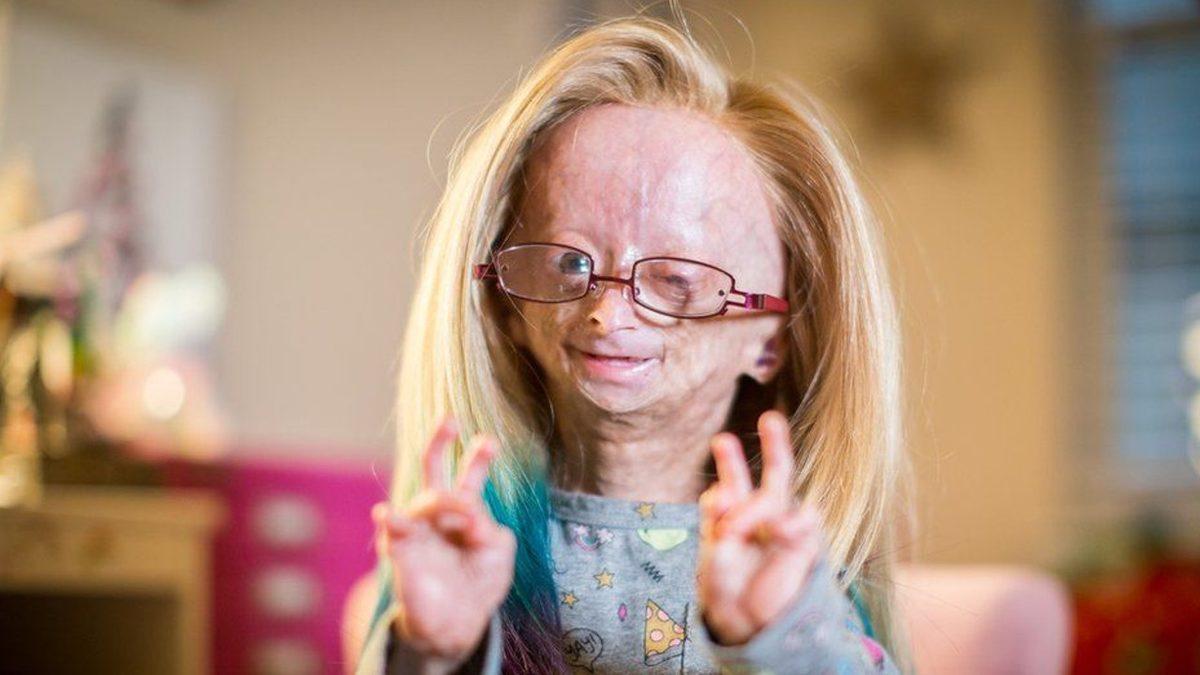 ’Benjamin Button Hastalığı’ İle Mücadele Eden Ünlü YouTuber Adalia Rose Hayatını Kaybetti
