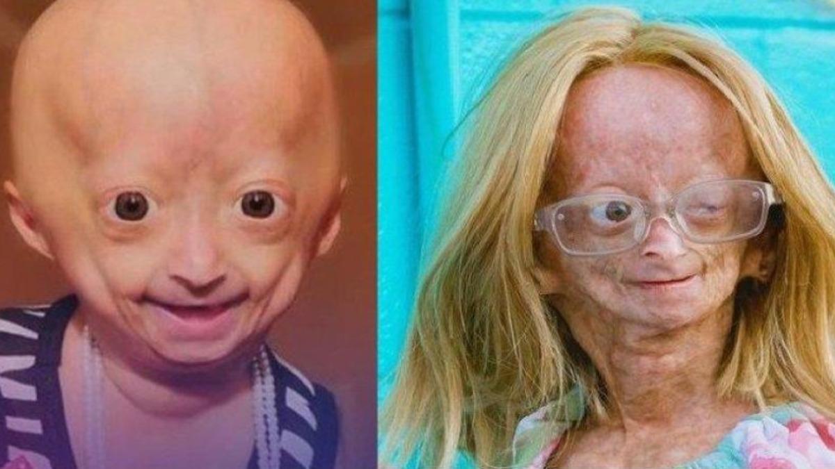 ’Benjamin Button Hastalığı’ İle Mücadele Eden Ünlü YouTuber Adalia Rose Hayatını Kaybetti