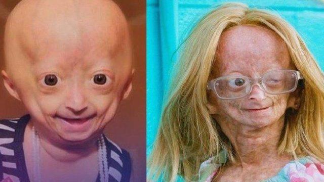 ’Benjamin Button Hastalığı’ İle Mücadele Eden Ünlü YouTuber Adalia Rose Hayatını Kaybetti