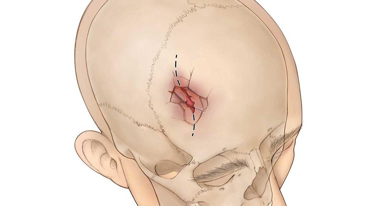 Bazı İnsanlar, Tam Kafalarından Vurulsalar Bile Nasıl Hayatta Kalıyorlar?