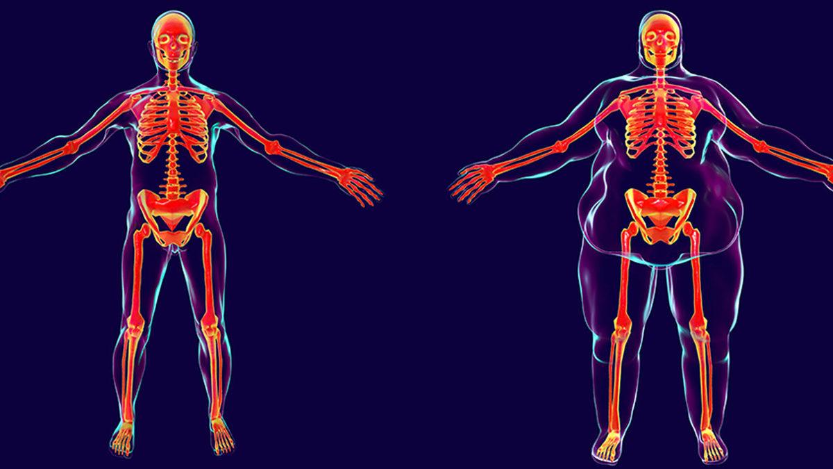 Obezite, Kansere Yol Açıyor: Nedeni İlk Kez Bilimsel Olarak Açıklandı