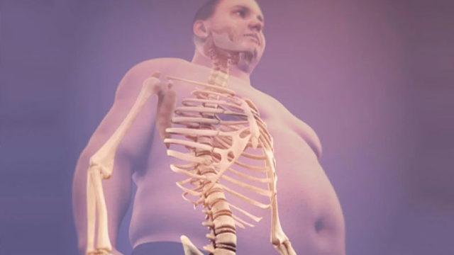 Obezite, Kansere Yol Açıyor: Nedeni İlk Kez Bilimsel Olarak Açıklandı