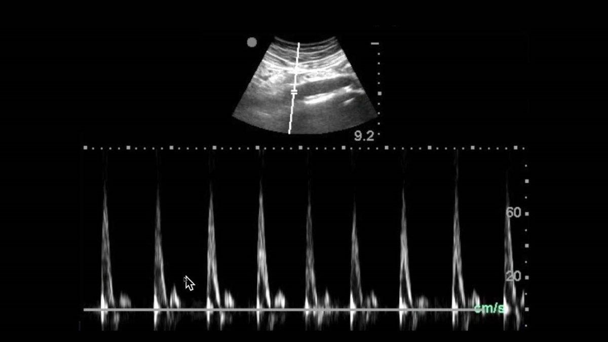 Ultrason Nedir, Nasıl Çalışır, Çeşitleri Nedir?