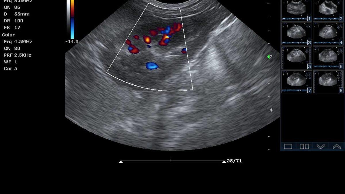 Ultrason Nedir, Nasıl Çalışır, Çeşitleri Nedir?