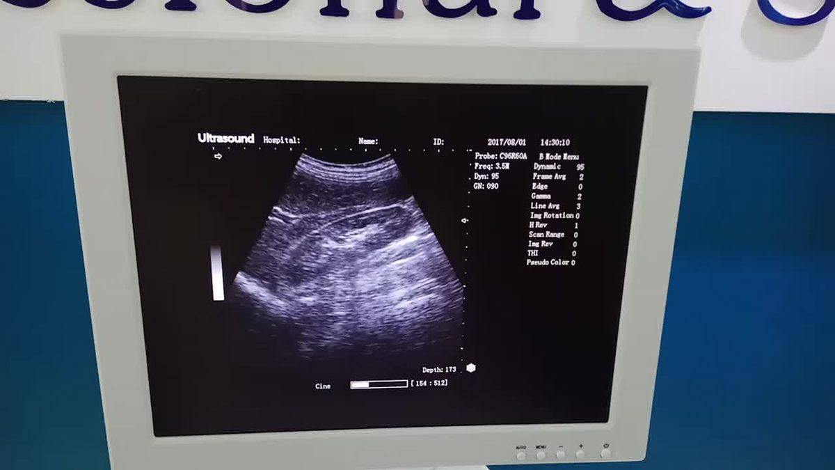 Ultrason Nedir, Nasıl Çalışır, Çeşitleri Nedir?