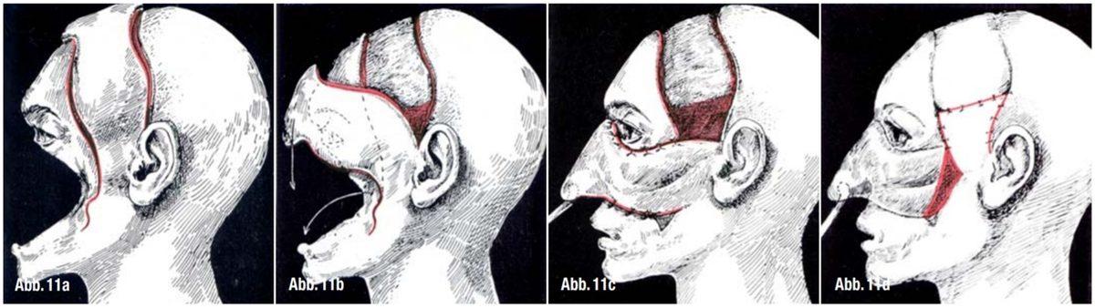 Çanakkale Savaşı’nda Yüzü Parçalanan Türk Asker ile Ona Yüz Estetiği Yapan Alman Doktorun Çarpıcı Hikâyesi