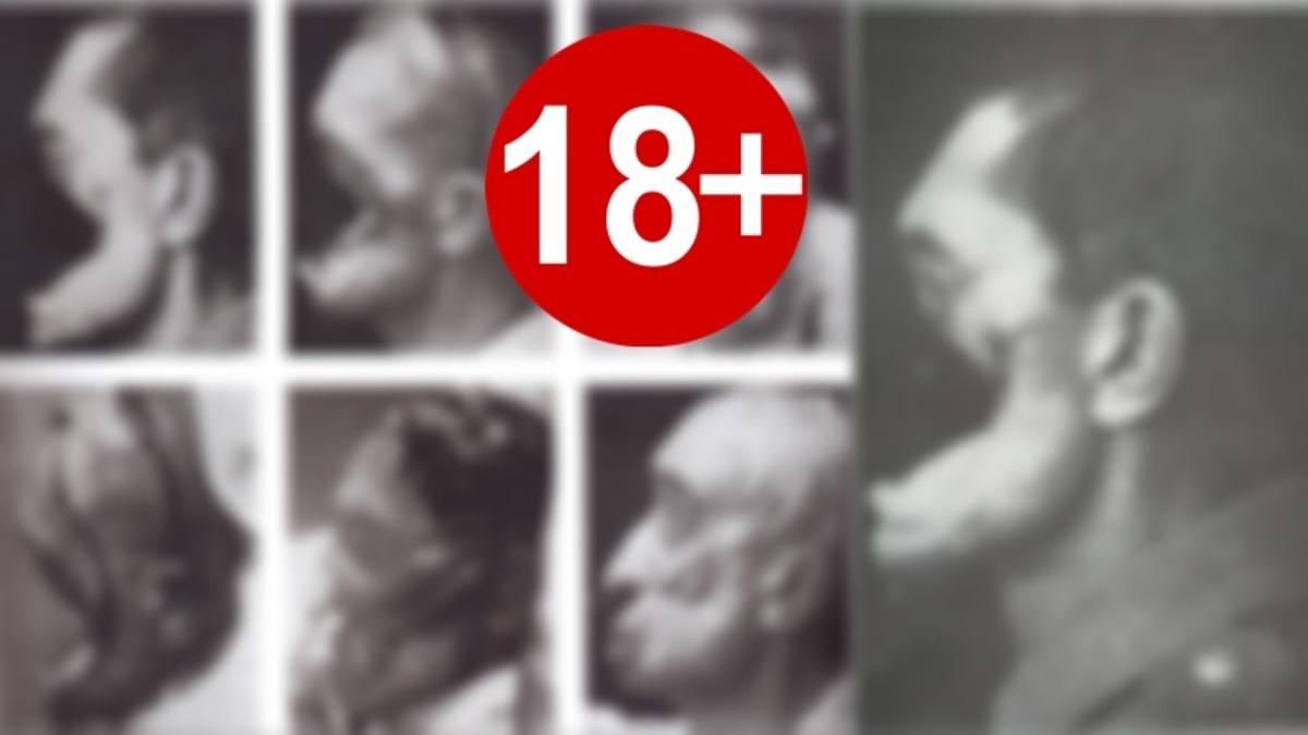 Çanakkale Savaşı’nda Yüzü Parçalanan Türk Asker ile Ona Yüz Estetiği Yapan Alman Doktorun Çarpıcı Hikâyesi