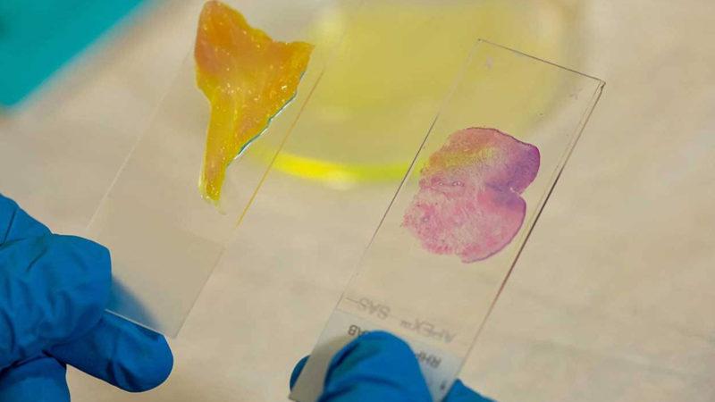 Kansere Karşı Mücadelede Yapay Zekâ Destekli Mikroskop Kullanılacak