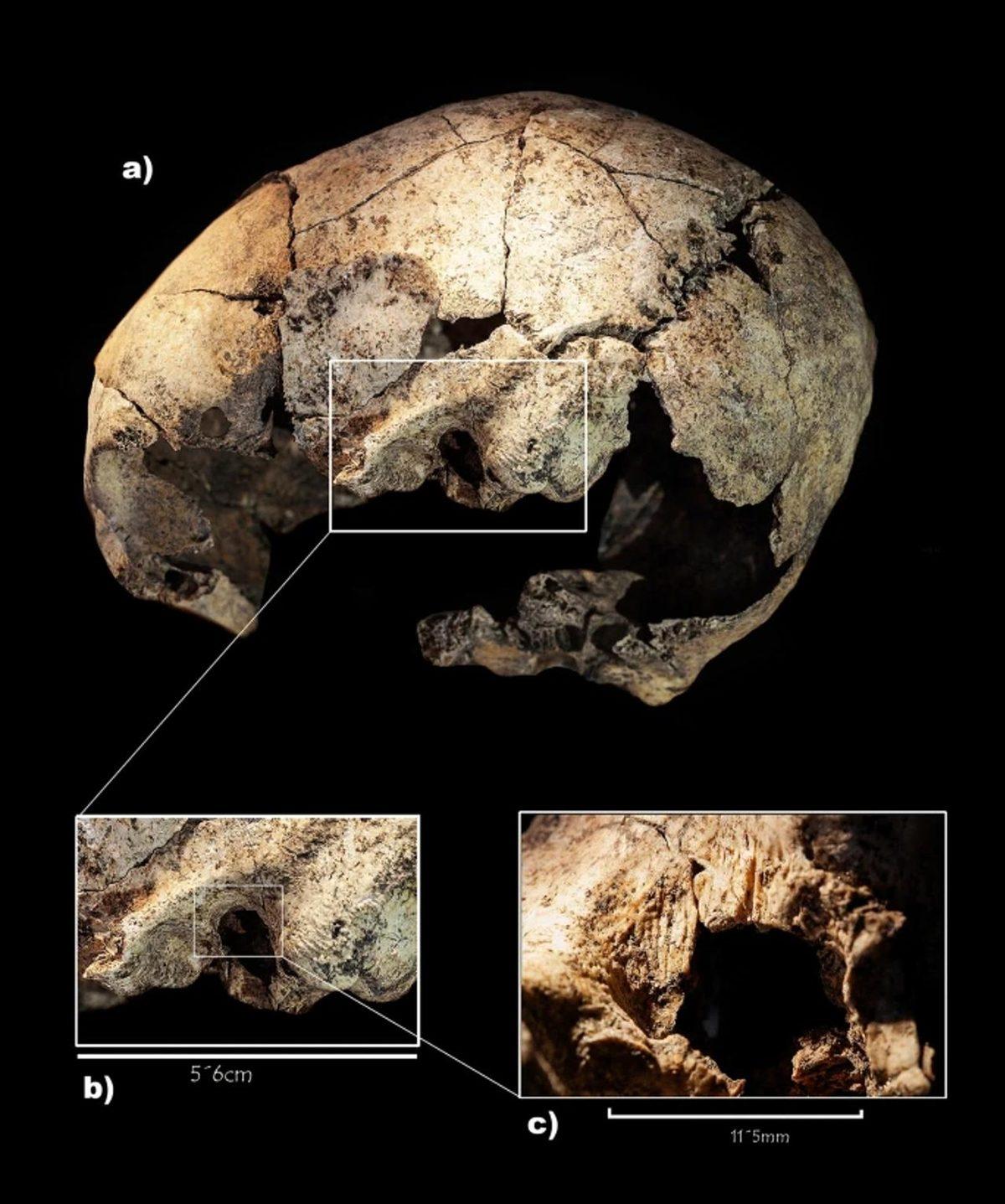 6 Bin Yıllık Kafatasında Tarihin İlk Başarılı Kulak Ameliyatına Dair İzler Bulundu
