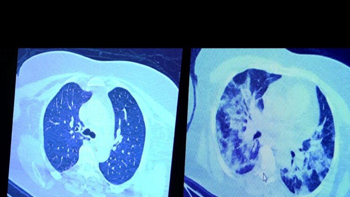 Prof. Özkaya, Covid-19 Tedavisini Reddeden Bir Hastanın Akciğerindeki Korkunç Tahribatı Gösterdi
