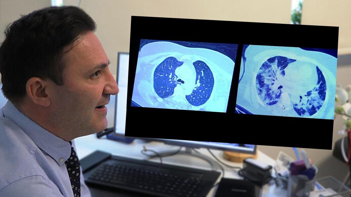 Prof. Özkaya, Covid-19 Tedavisini Reddeden Bir Hastanın Akciğerindeki Korkunç Tahribatı Gösterdi