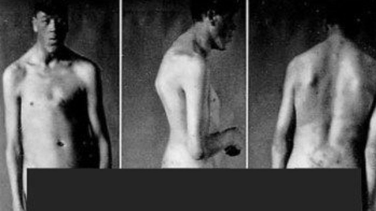 Dünyaya Bir Cüce Olarak Gelip Dev Olarak Yaşamını Yitiren Adam Rainer’ın Şaşkınlık Veren Hikayesi